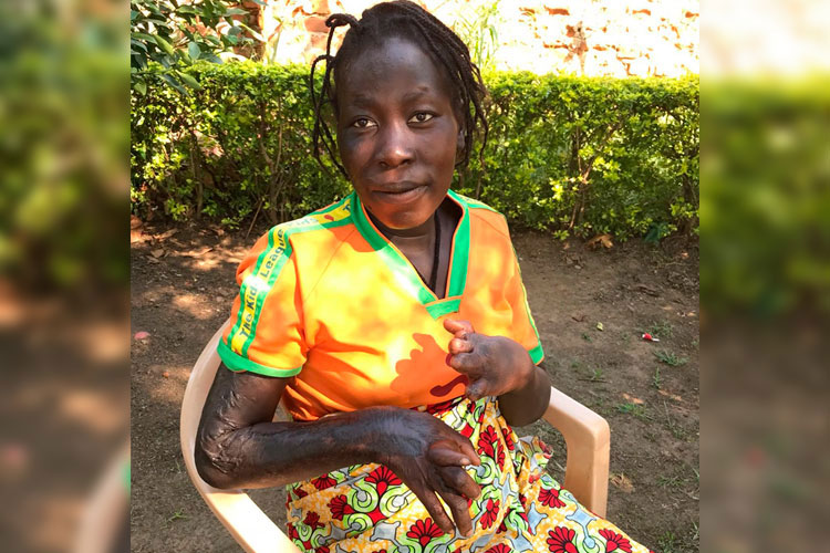 Picture of Ketty, a burn victim in Africa