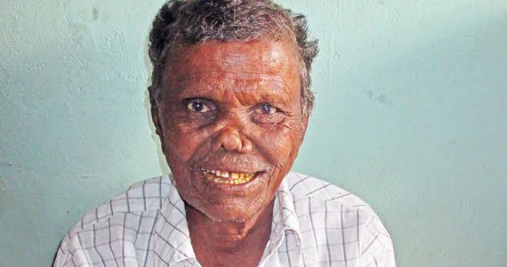 brother eliah, a leprosy-infected patient now home with the Lord