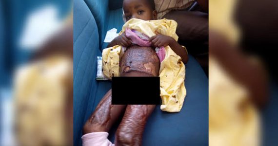 Picture of baby with keloids after being burned