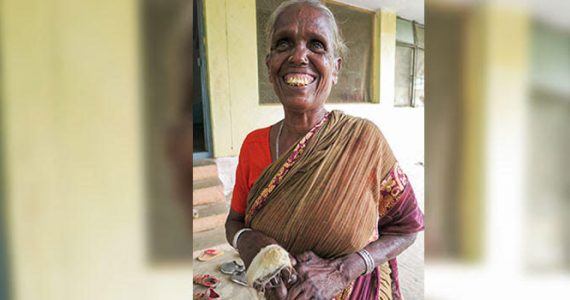 Picture of leprosy patient