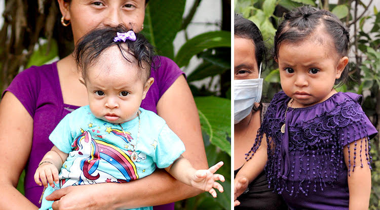 Malnourished child in Guatemala - before and after